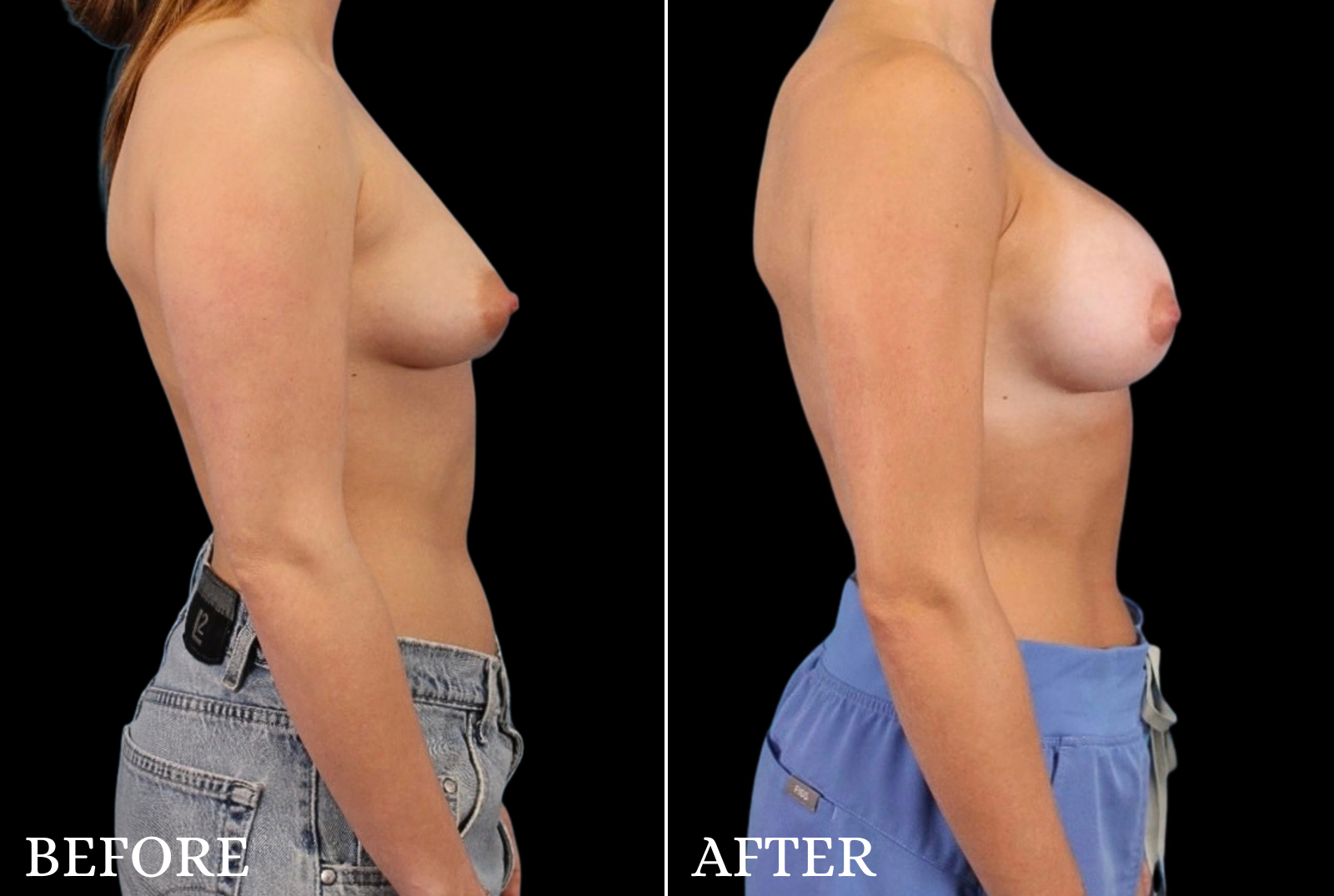 Breast Lift with Implant Before & After Gallery - Patient 163389 - Image 3