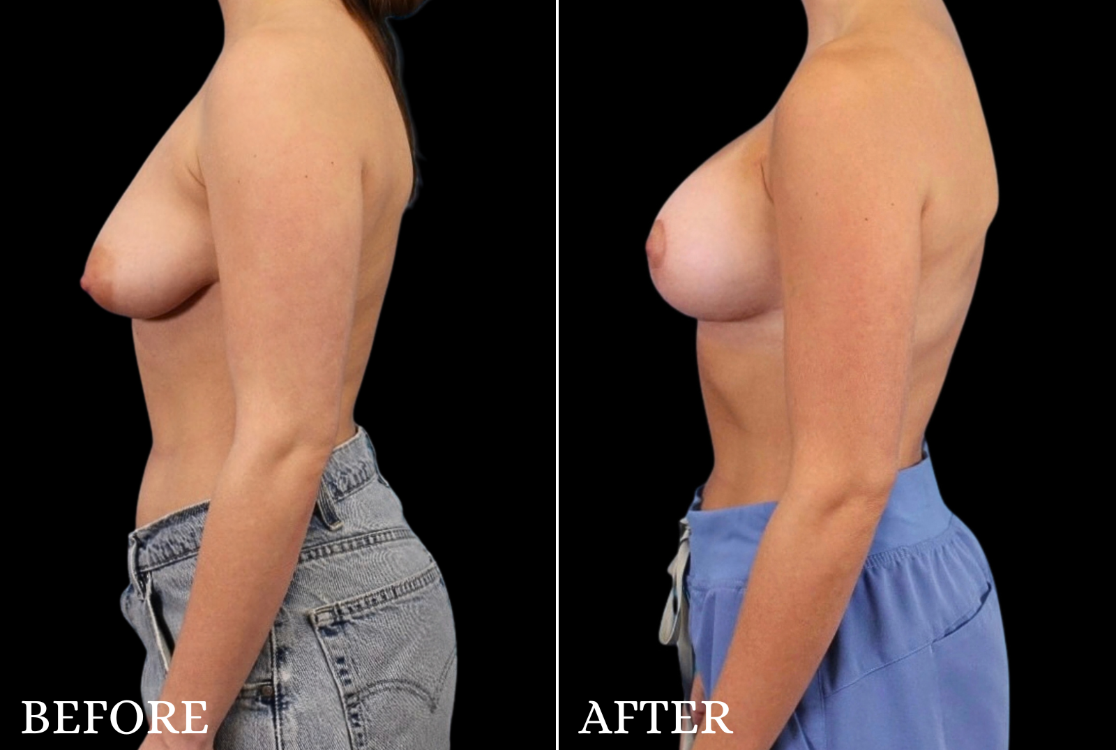 Breast Lift with Implant Before & After Gallery - Patient 163389 - Image 5