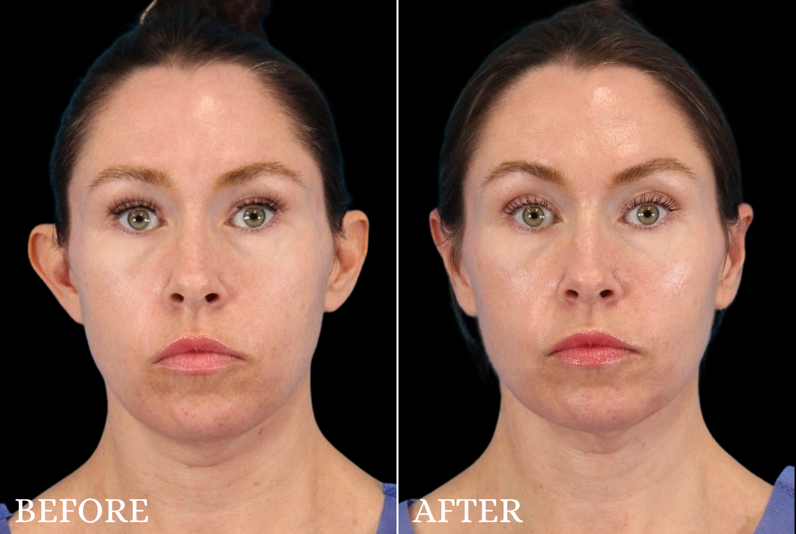 Otoplasty Before & After Gallery - Patient 205659 - Image 1