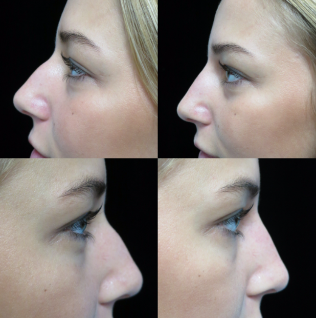 before and after photos of a female patient after liquid nose job