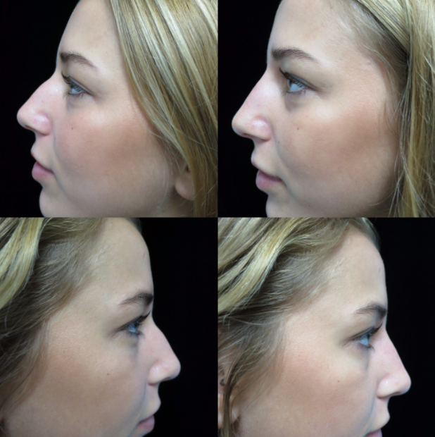 before and after photos of a female patient after non surgical nose job