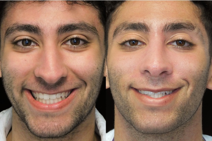 Male bulbous tip rhinoplasty patient