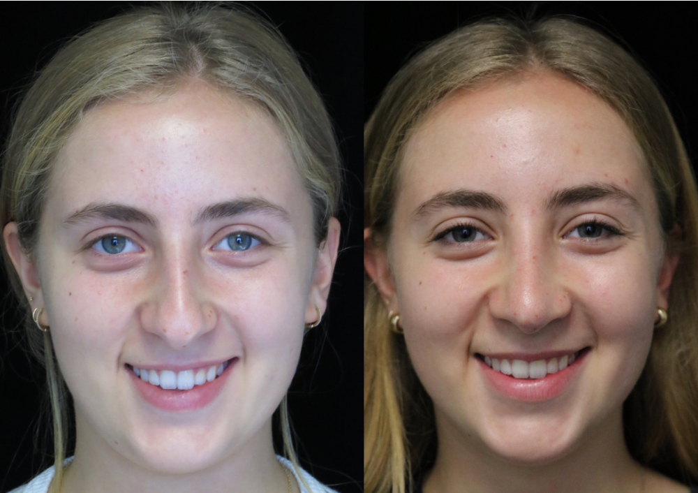 Teenage bulbous nose job patient