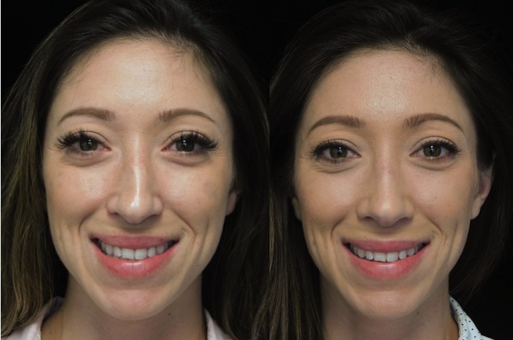Asian scarless rhinoplasty patient