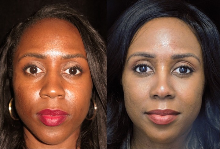 Ethnic scarless rhinoplasty patient