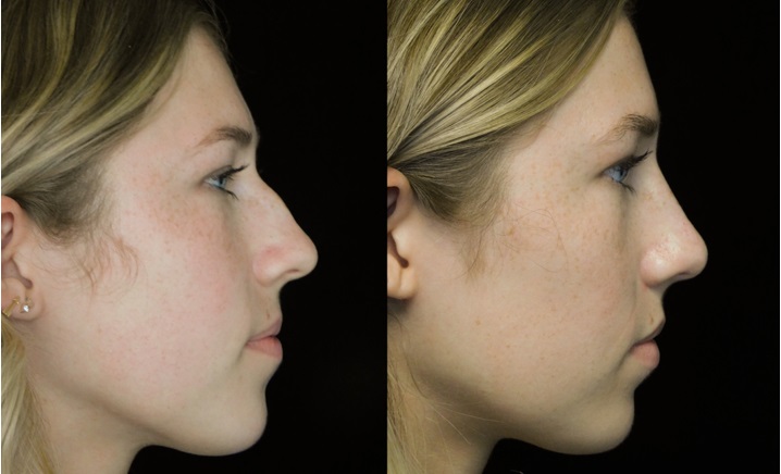 Russian closed rhinoplasty patient