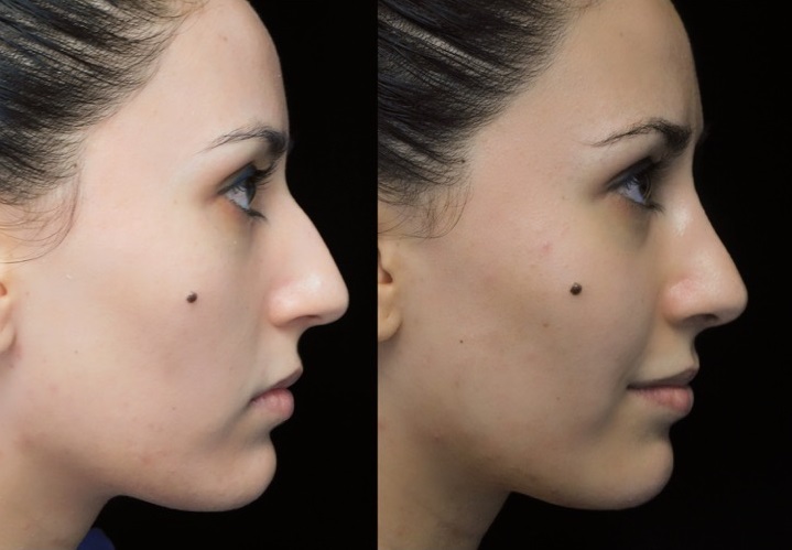 European scarless rhinoplasty patient