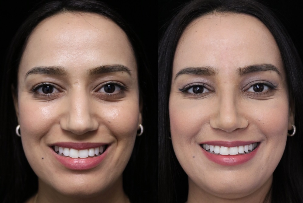 Middle Eastern scarless rhinoplasty patient