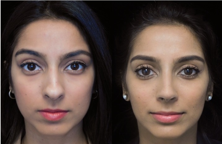 Indian or South Asian nonsurgical rhinoplasty patient