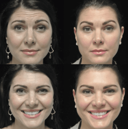 before and after photo of a female patient who underwent botox anti aging