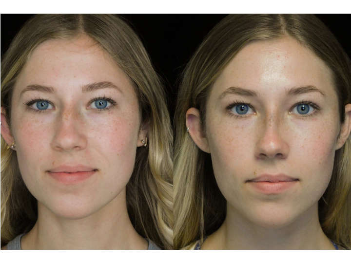 before and after photo of a young woman with a bulbous tip nose who underwent bulbous tip reduction