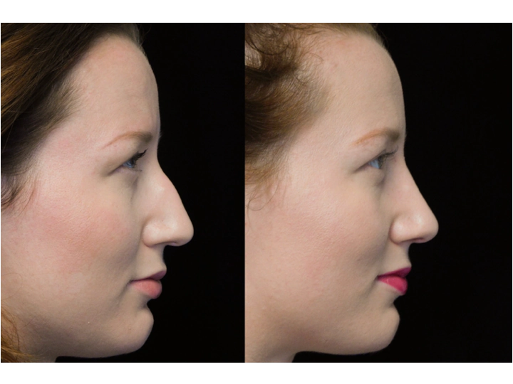 before and after photo of a young woman with a bulbous tip nose who underwent bulbous tip reduction