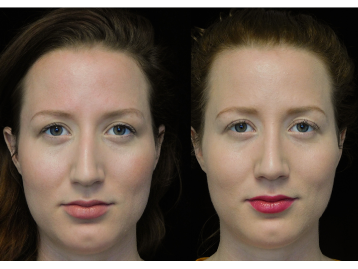 before and after photo of a young woman with a bulbous tip nose who underwent bulbous tip reduction