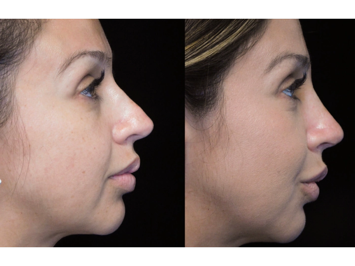 before and after photo of a young woman with a bulbous tip nose who underwent bulbous tip reduction