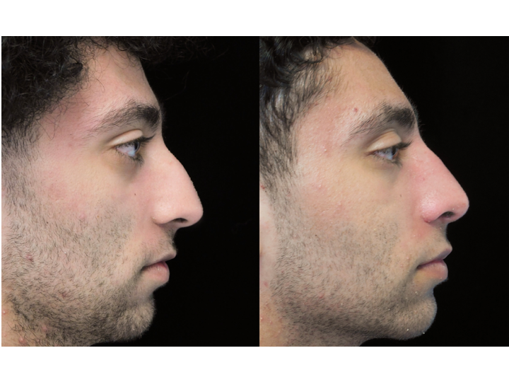 a man with a before and after nose job bulbous tip photo