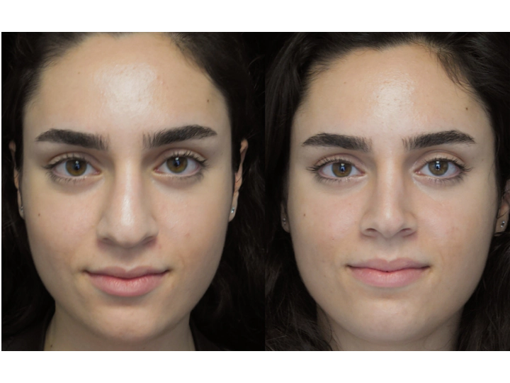 Getting a bulbous nose job Scarless Med Spa by Deepak Dugar M.D