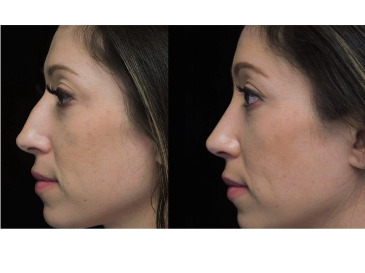 before and after photo of a woman who underwent a nose job tip reduction