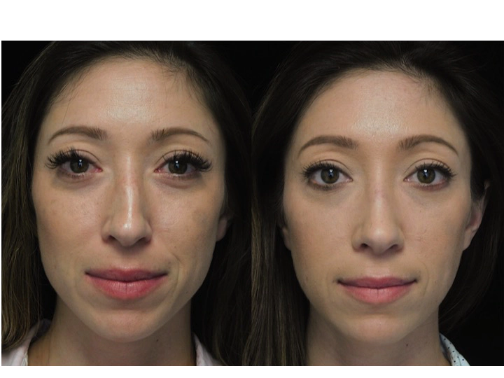 before and after photo of a woman who underwent a nose job tip reduction