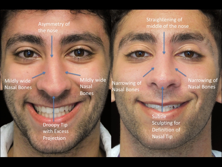 Illustration of a male patient with droopy nose tip who underwent a Scarless Nose® surgery tip refinement