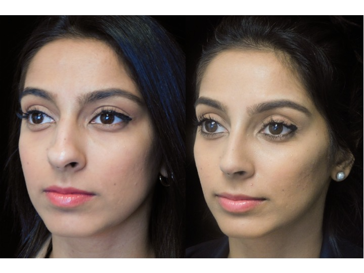 Illustration of a woman who underwent Scarless Nose® surgery tip refinement