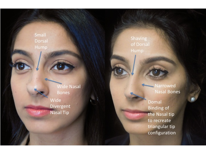 Illustration of a woman who underwent closed rhinoplasty tip refinement