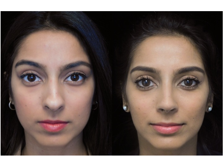 Illustration of a woman who underwent closed rhinoplasty tip refinement