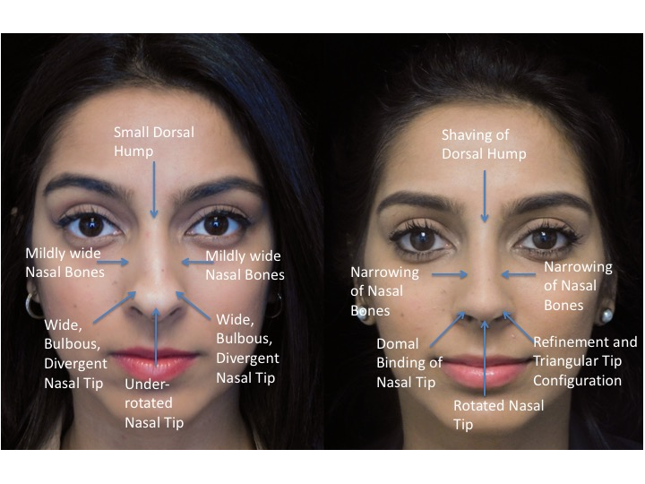 Illustration of a woman who underwent closed rhinoplasty tip refinement