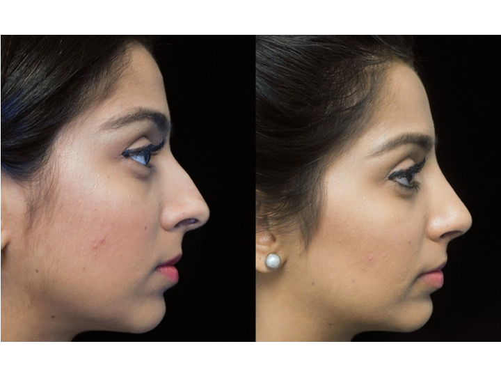 Illustration of a woman who underwent closed rhinoplasty tip refinement