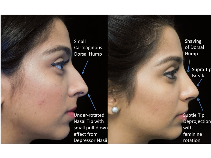 Illustration of a woman who underwent closed rhinoplasty tip refinement