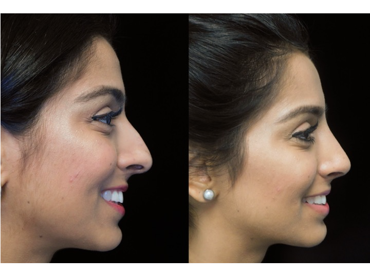 Illustration of a woman who underwent closed rhinoplasty tip refinement