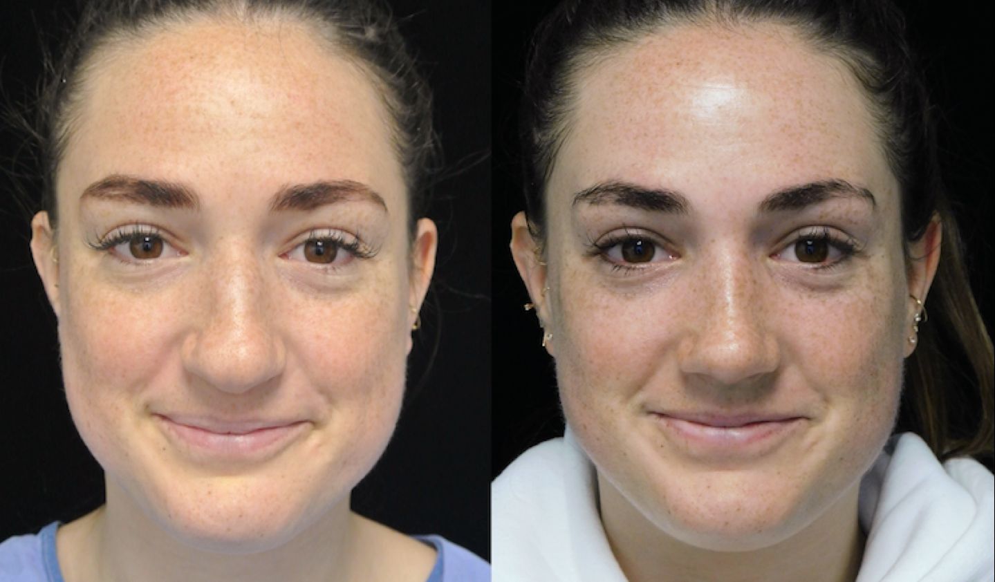 a woman who underwent rhinoplasty before and after illustration