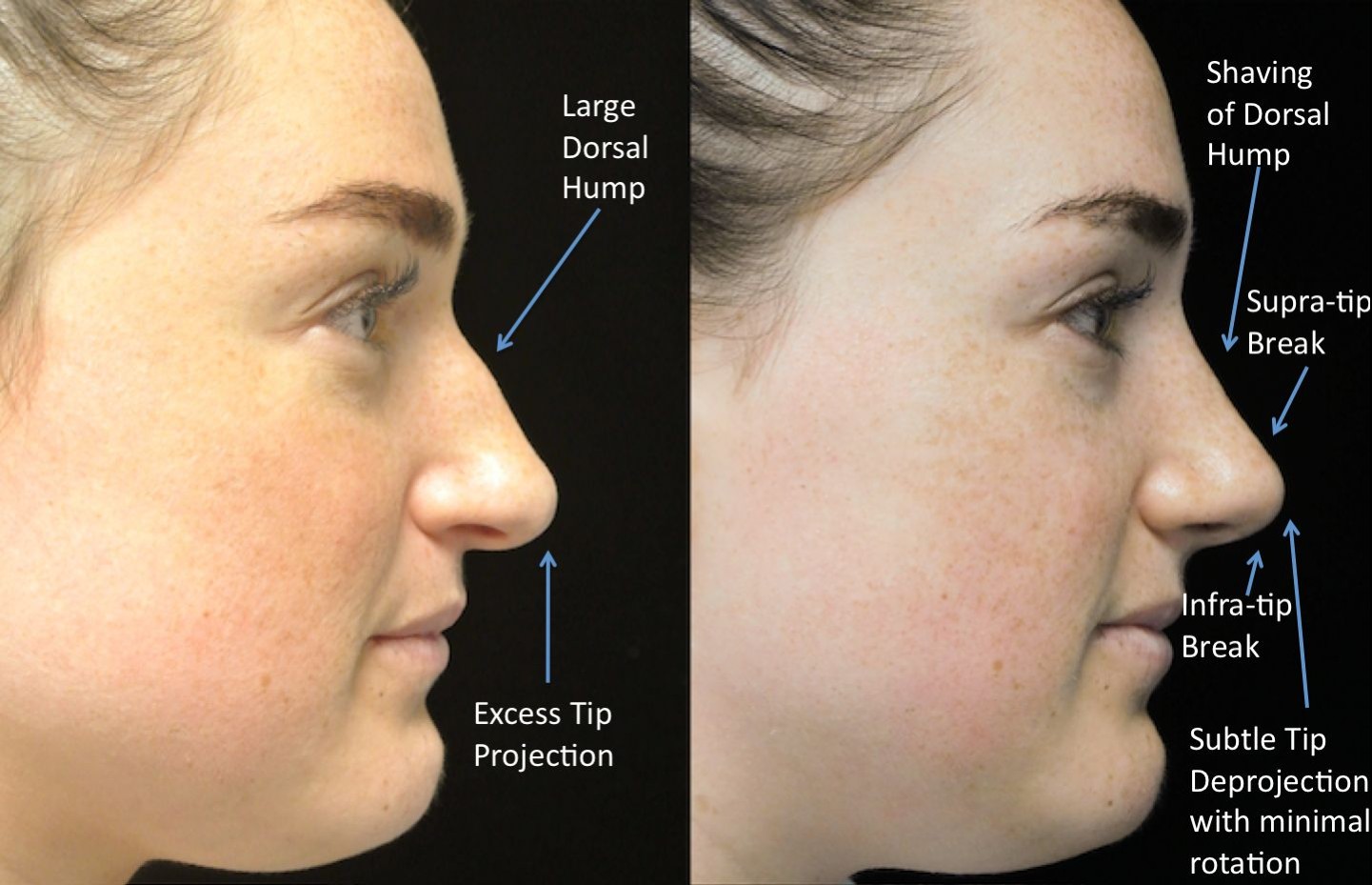 a woman who underwent rhinoplasty before and after illustration