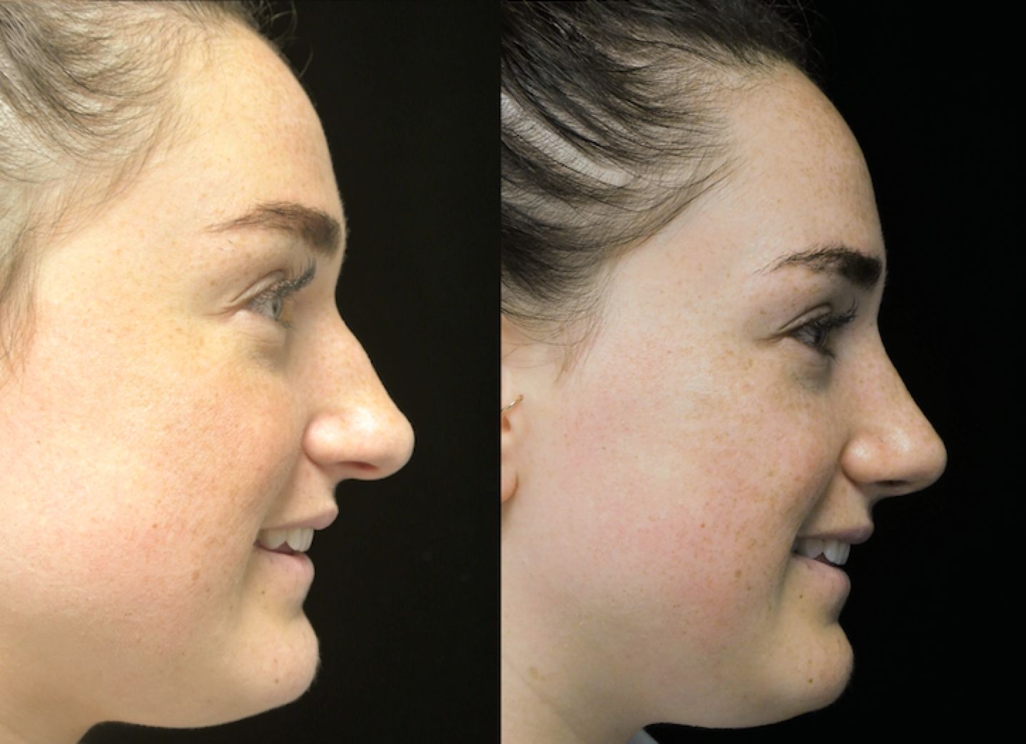 a woman who underwent rhinoplasty before and after illustration