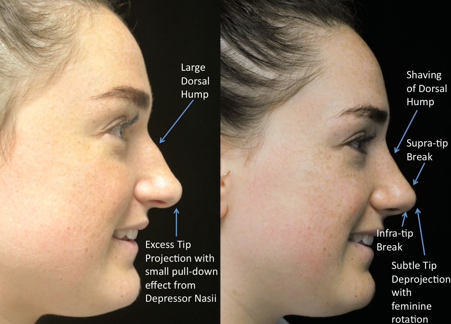 a woman who underwent rhinoplasty before and after illustration