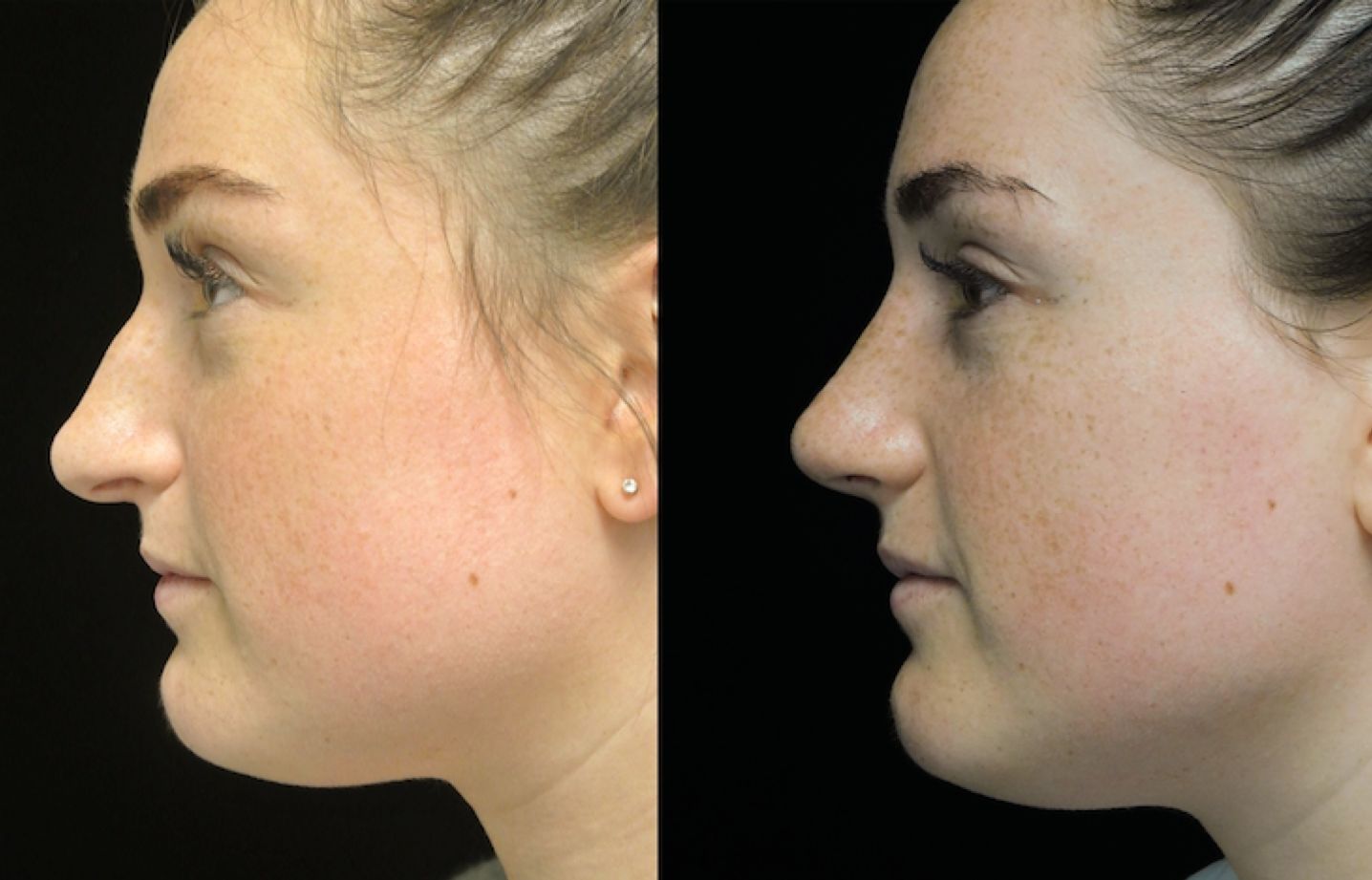 a woman who underwent rhinoplasty before and after illustration