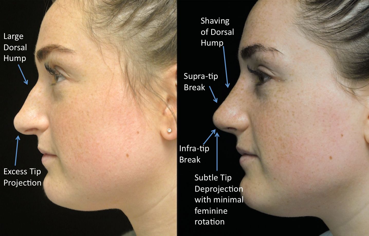 a woman who underwent rhinoplasty before and after illustration