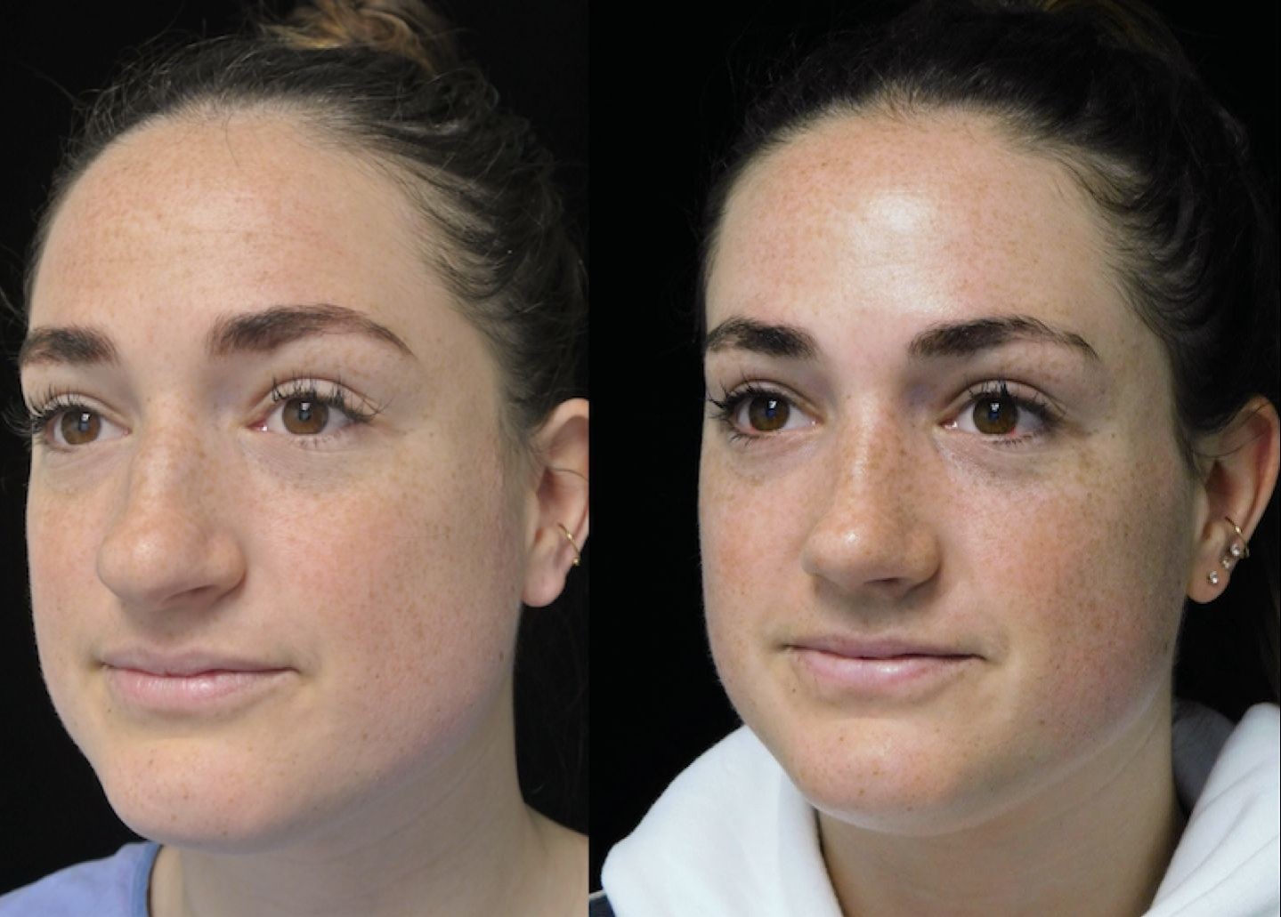 a woman who underwent rhinoplasty before and after illustration