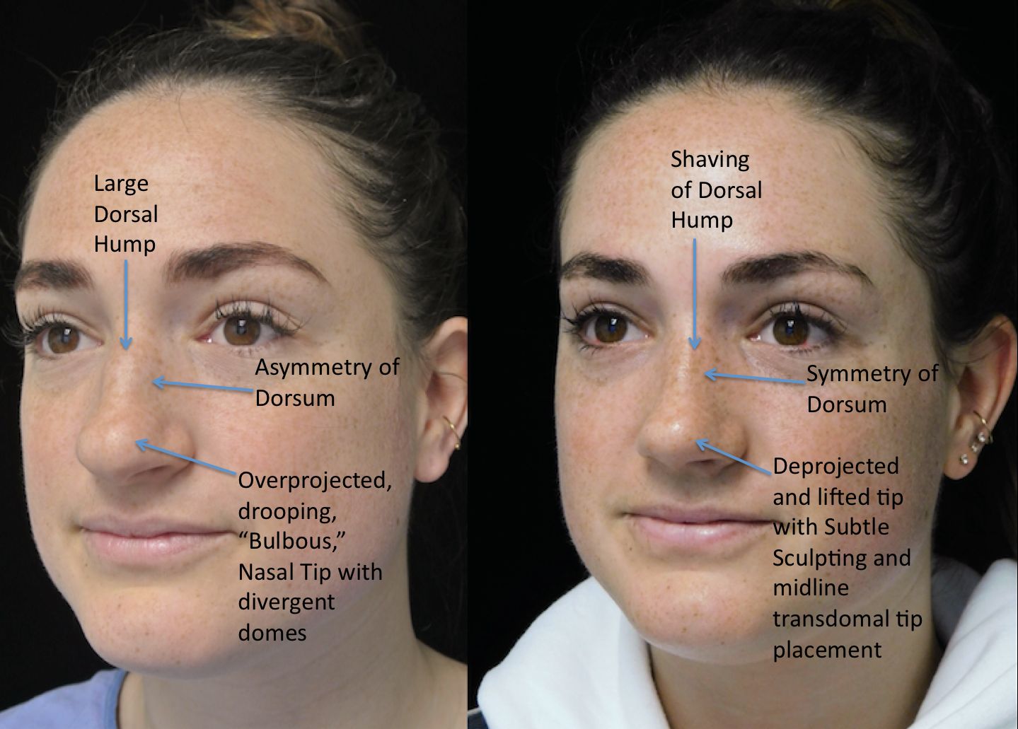 a woman who underwent rhinoplasty before and after illustration