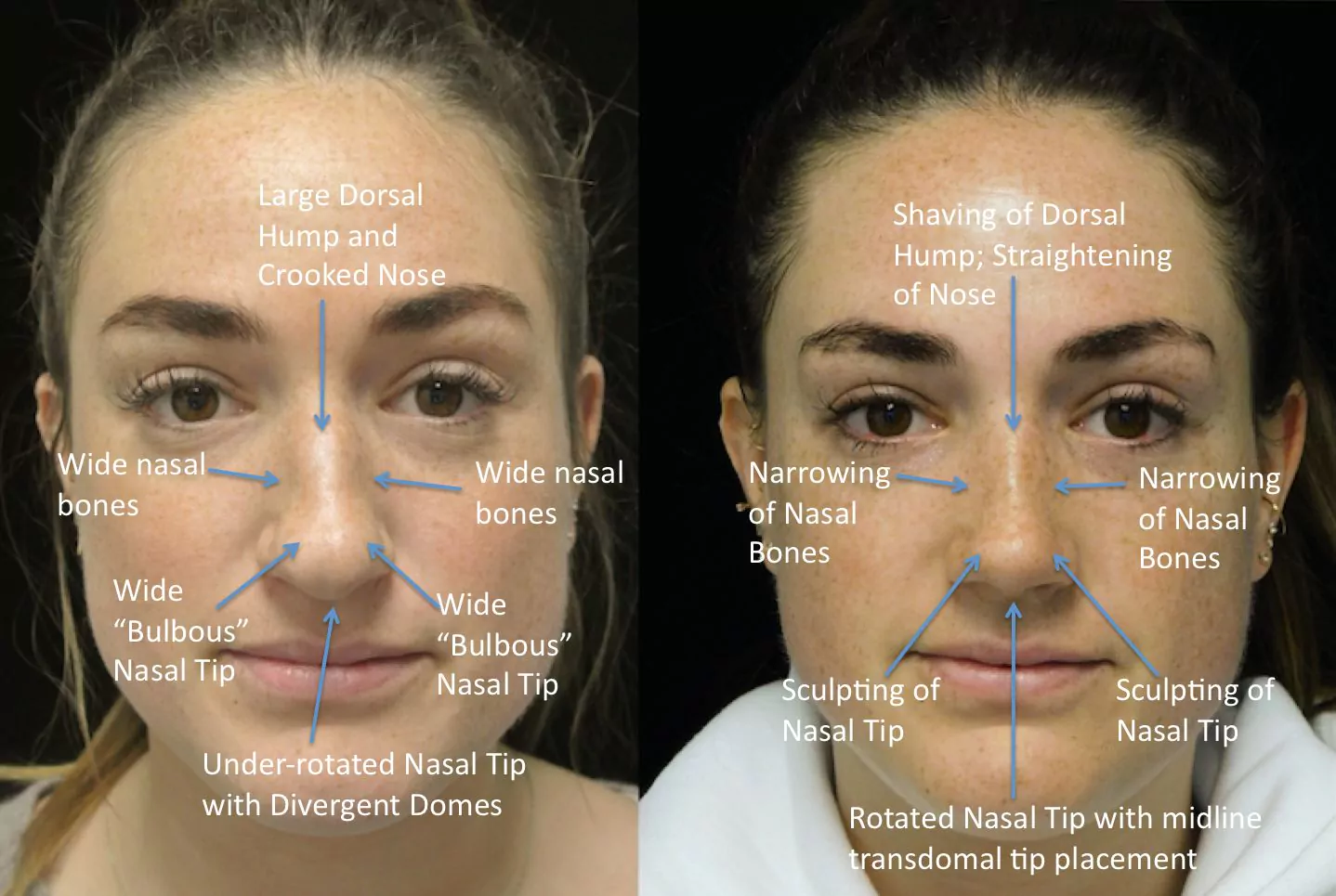 a woman who underwent rhinoplasty before and after illustration