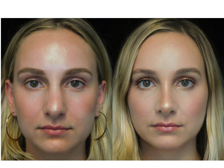 closed rhinoplasty before and after illustration of a woman with wide bulbous nasal tip