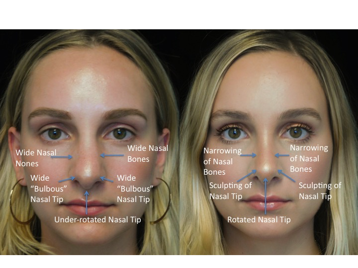 closed rhinoplasty before and after illustration of a woman with wide bulbous nasal tip
