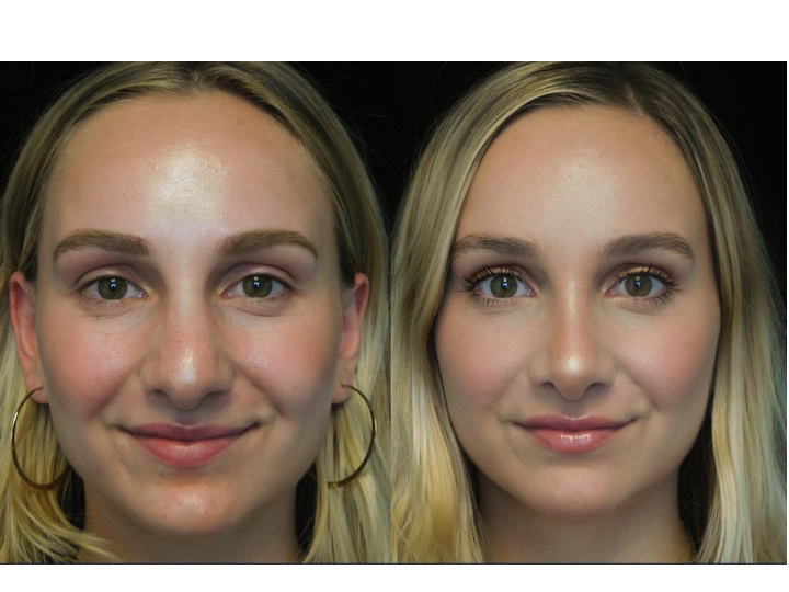 closed rhinoplasty before and after illustration of a woman with wide bulbous nasal tip
