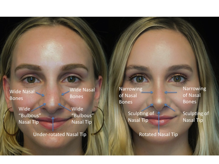 closed rhinoplasty before and after illustration of a woman with wide bulbous nasal tip