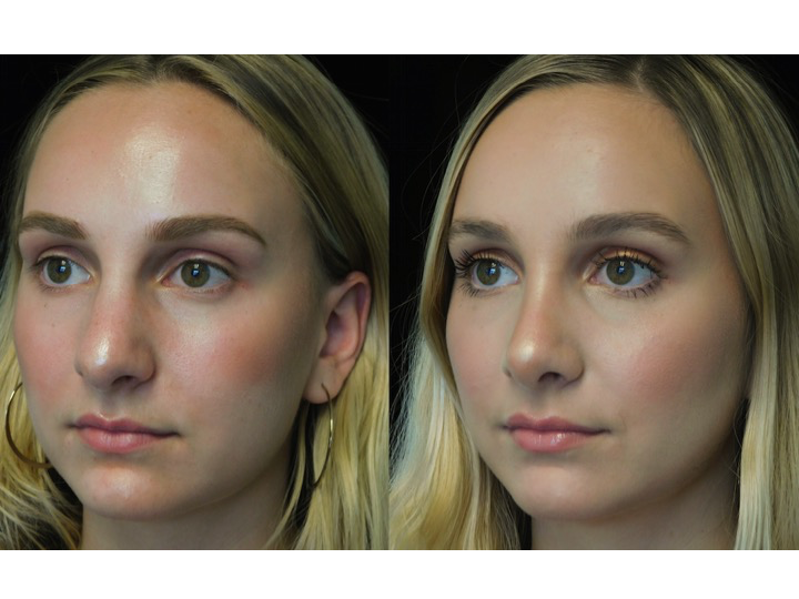 closed rhinoplasty before and after illustration of a woman with wide bulbous nasal tip