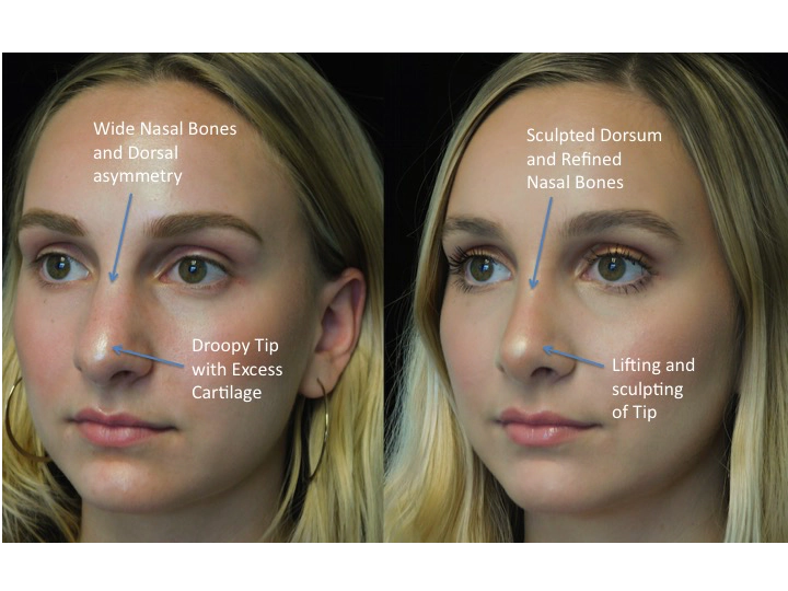 closed rhinoplasty before and after illustration of a woman with wide bulbous nasal tip