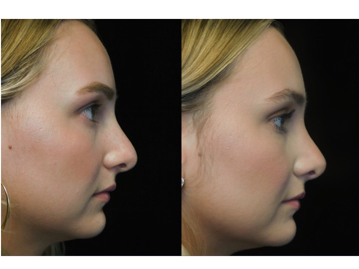 closed rhinoplasty before and after illustration of a woman with wide bulbous nasal tip