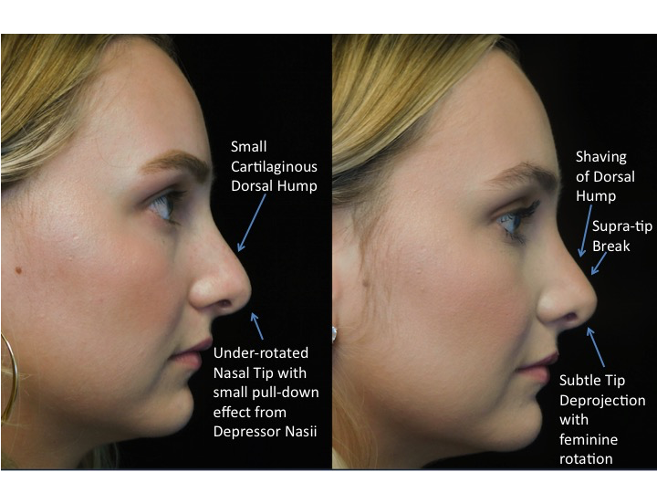 closed rhinoplasty before and after illustration of a woman with wide bulbous nasal tip