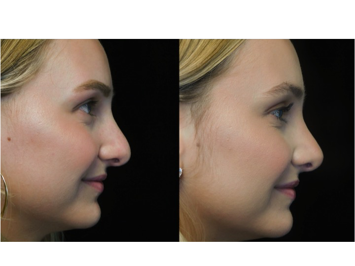 closed rhinoplasty before and after illustration of a woman with wide bulbous nasal tip