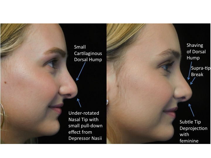 closed rhinoplasty before and after illustration of a woman with wide bulbous nasal tip
