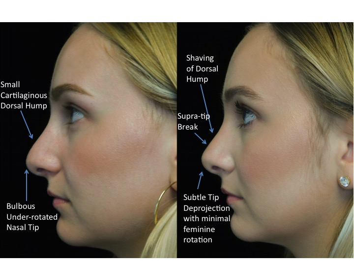 closed rhinoplasty before and after illustration of a woman with wide bulbous nasal tip